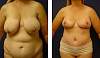 breast-reduction-18a.jpg