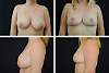 Breast Reduction Case 01121.jpg