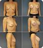 revis_breast_augmentation83.jpg
