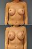 revis_breast_augmentation95.jpg